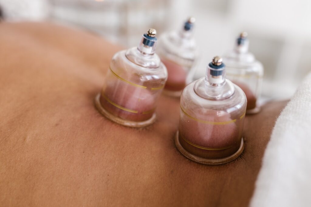 Cupping for muscle strain