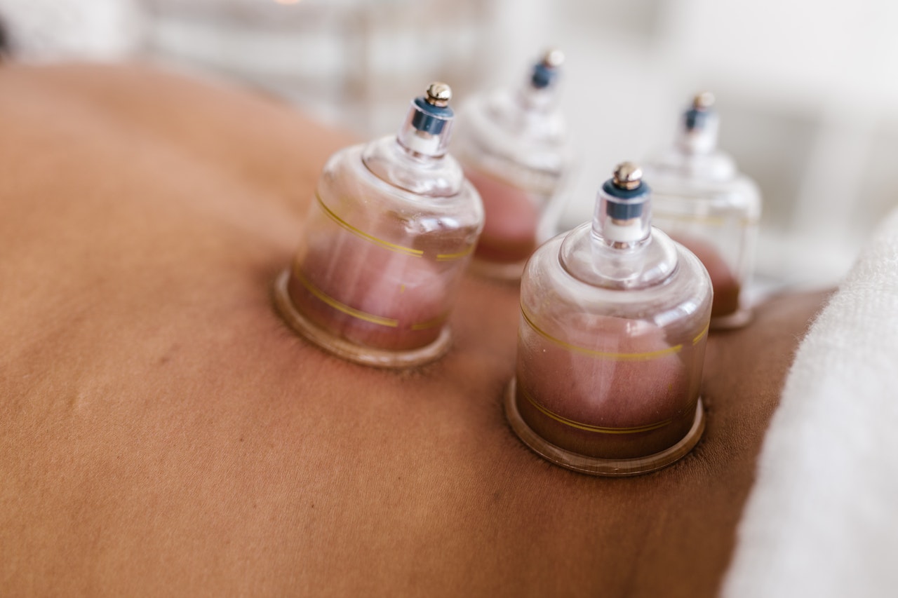 Cupping for muscle strain
